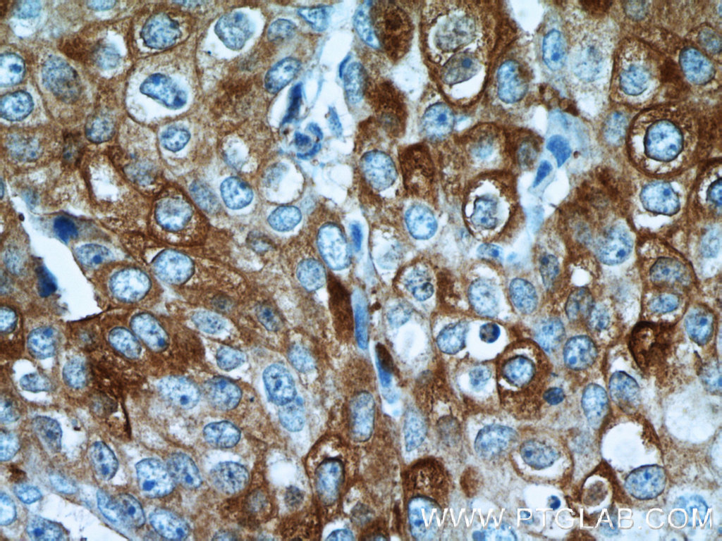 IHC staining of human breast cancer using 20629-1-AP