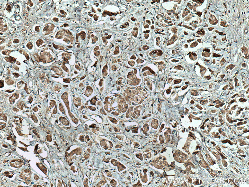 IHC staining of human breast cancer using 66923-1-Ig (same clone as 66923-1-PBS)