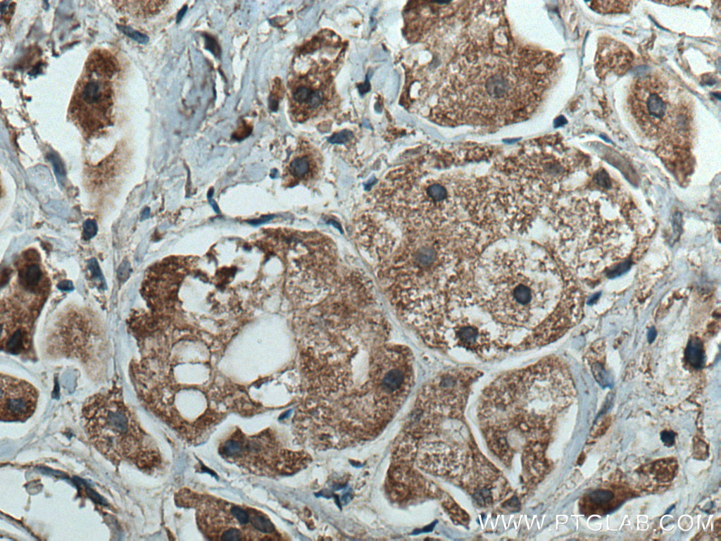 IHC staining of human breast cancer using 66923-1-Ig (same clone as 66923-1-PBS)
