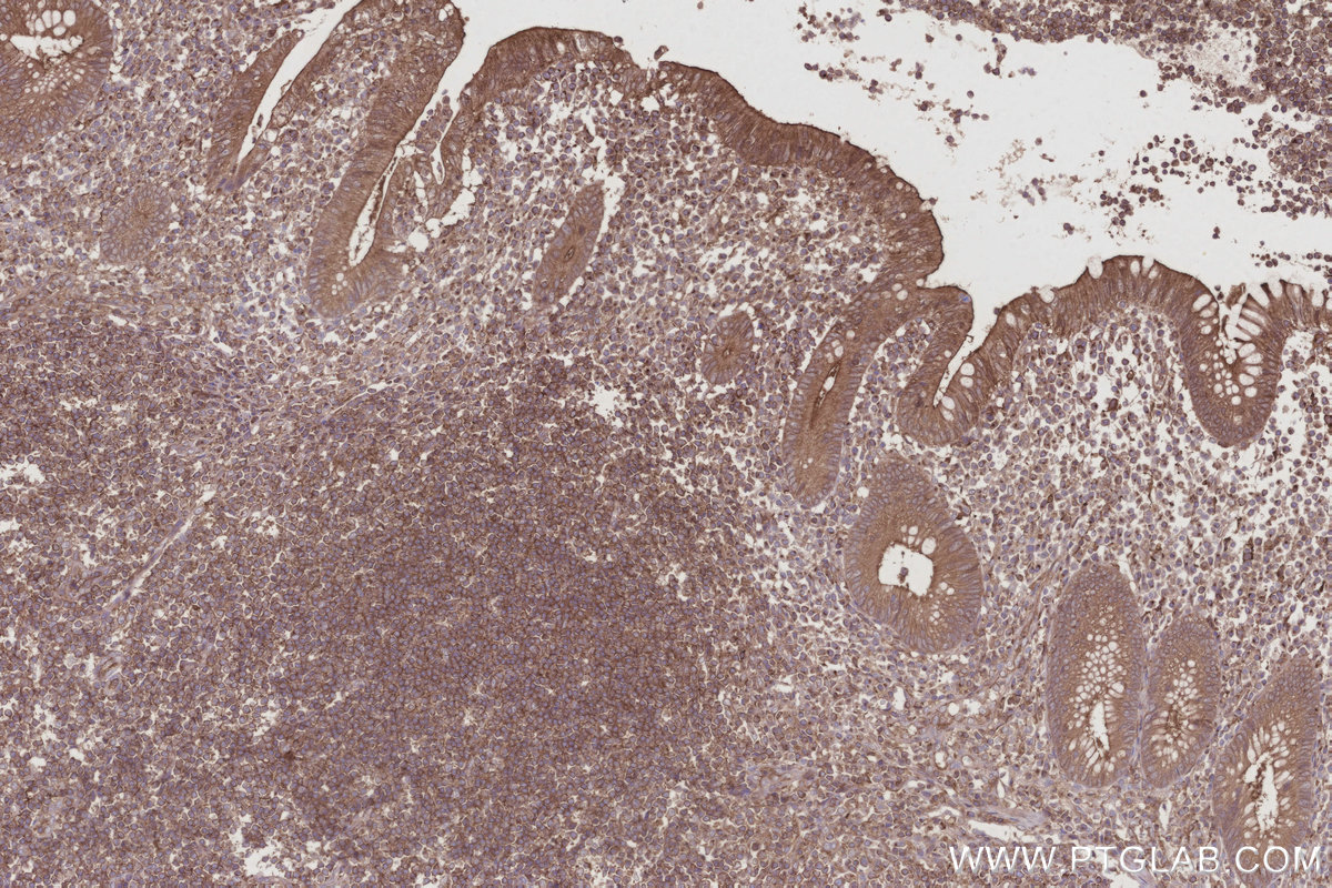 IHC staining of human appendicitis using 10847-1-AP IHC staining of human appendicitis using 10847-1-AP