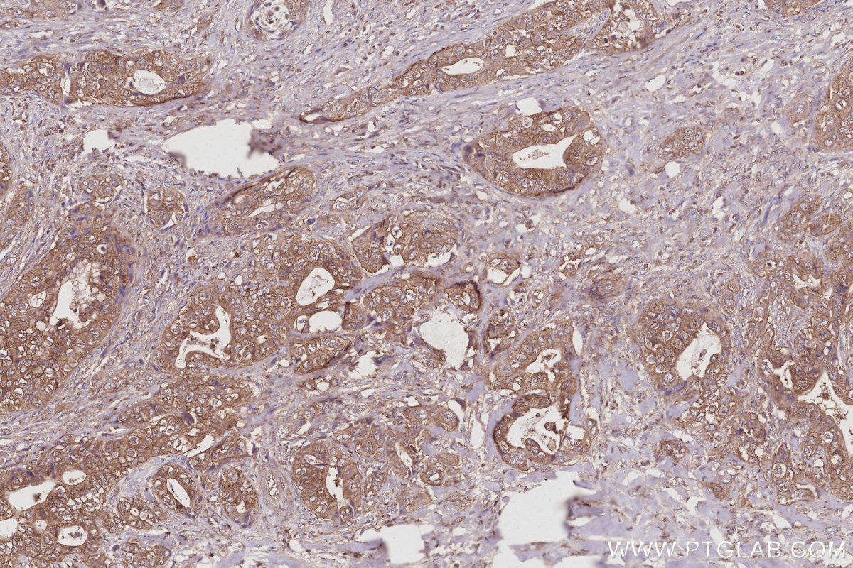 IHC staining of human pancreas cancer using 10847-1-AP IHC staining of human pancreas cancer using 10847-1-AP