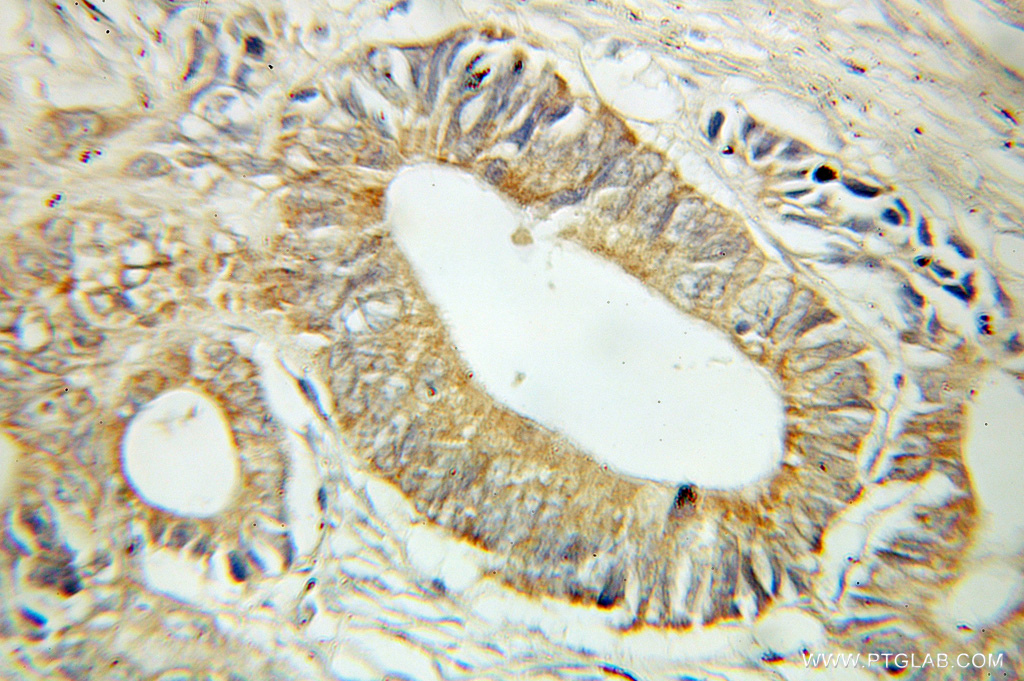 IHC staining of human colon cancer using 10847-1-AP