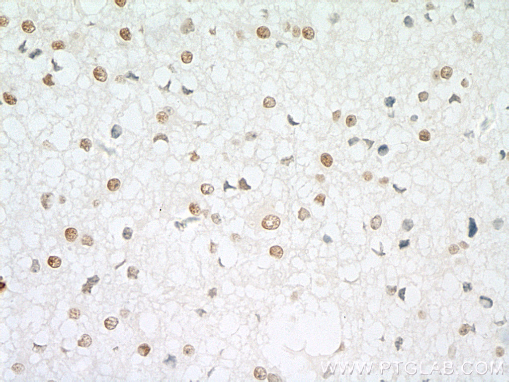 IHC staining of human gliomas using 10412-1-Ap