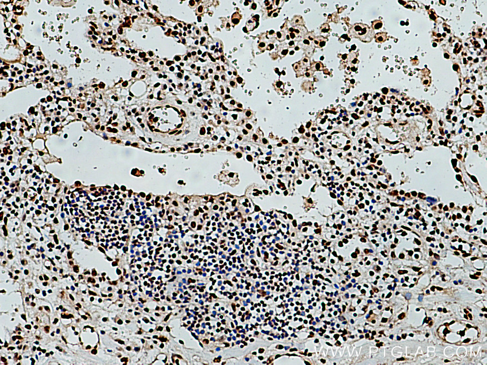 IHC staining of human lung cancer using 10692-1-AP