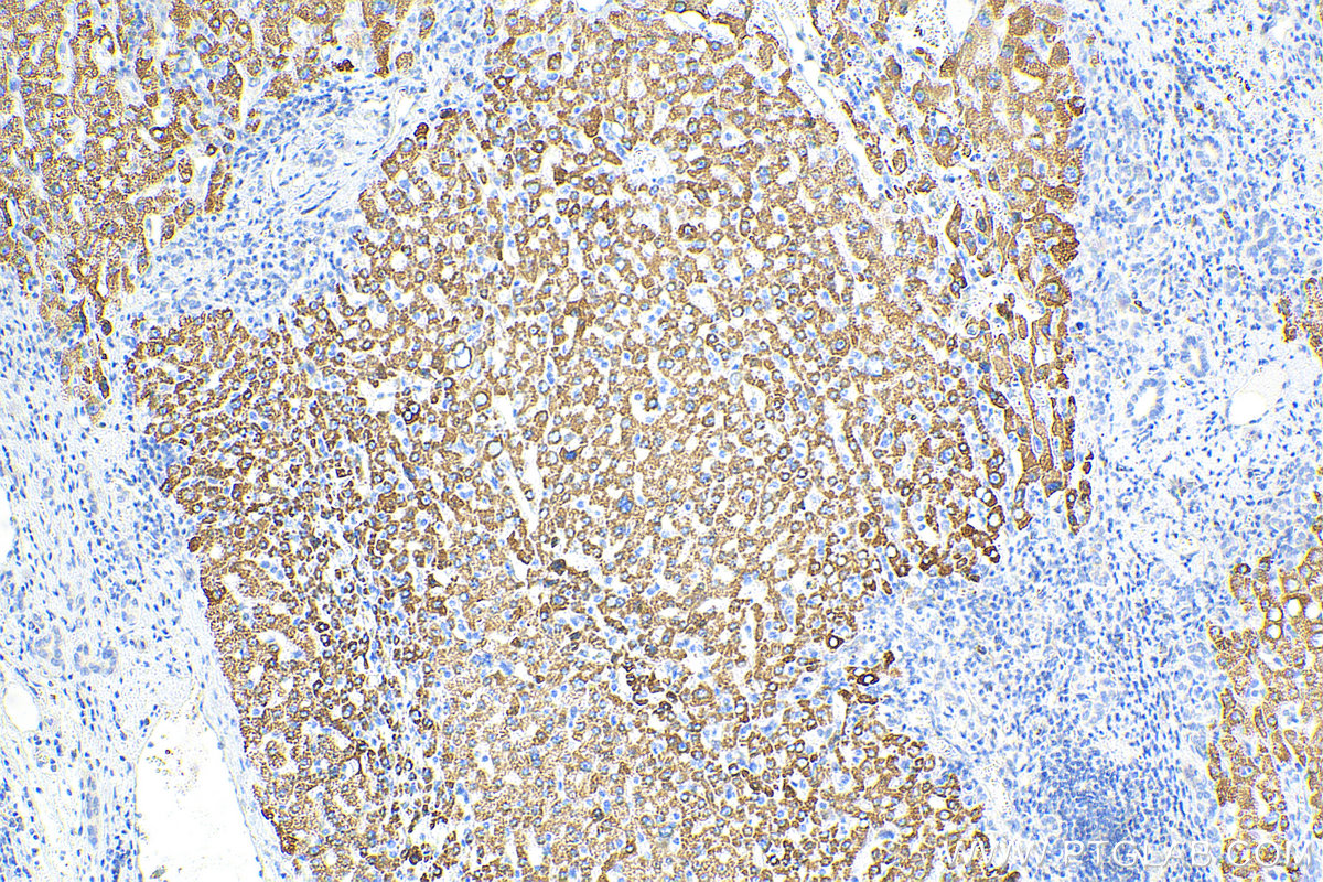 IHC staining of human liver cancer using 16277-1-AP