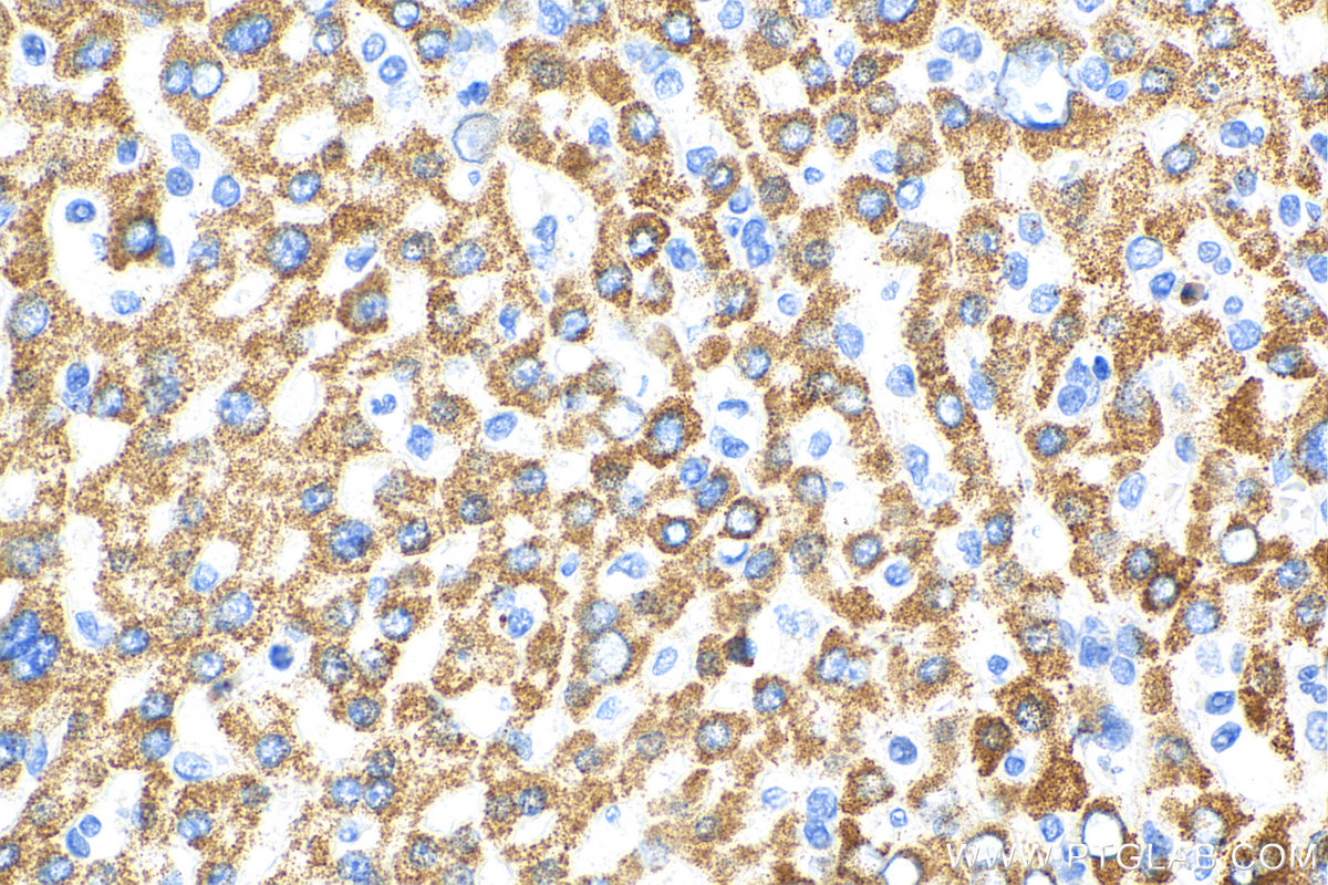 IHC staining of human liver cancer using 16277-1-AP