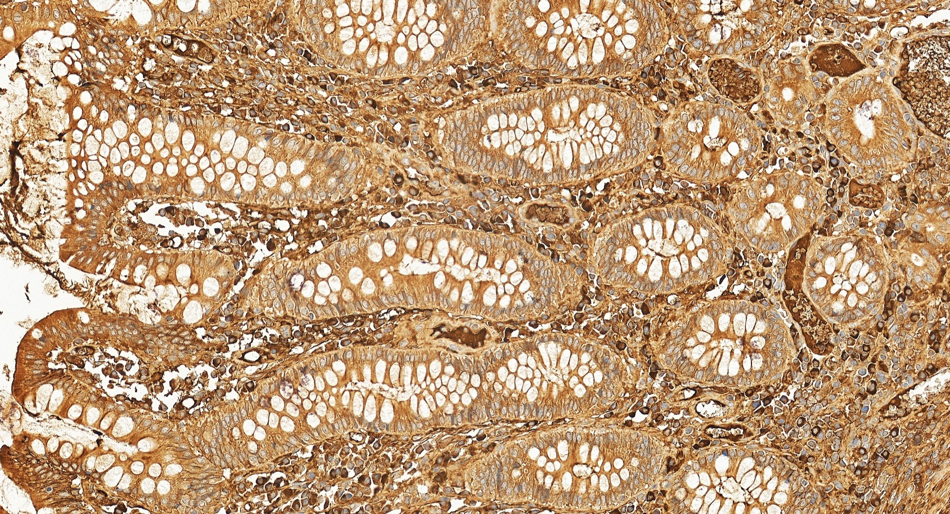IHC staining of human colon cancer using 11271-1-AP IHC staining of human colon cancer using 11271-1-AP