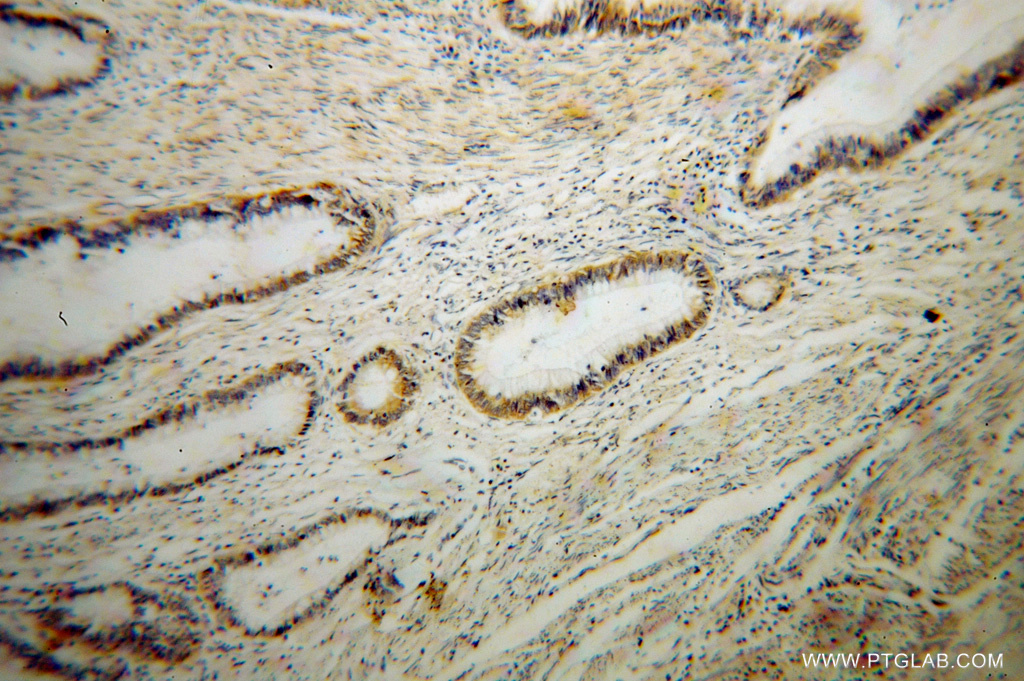 IHC staining of human colon cancer using 14991-1-AP