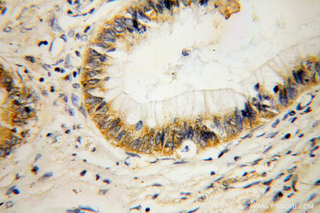 IHC staining of human colon cancer using 14991-1-AP