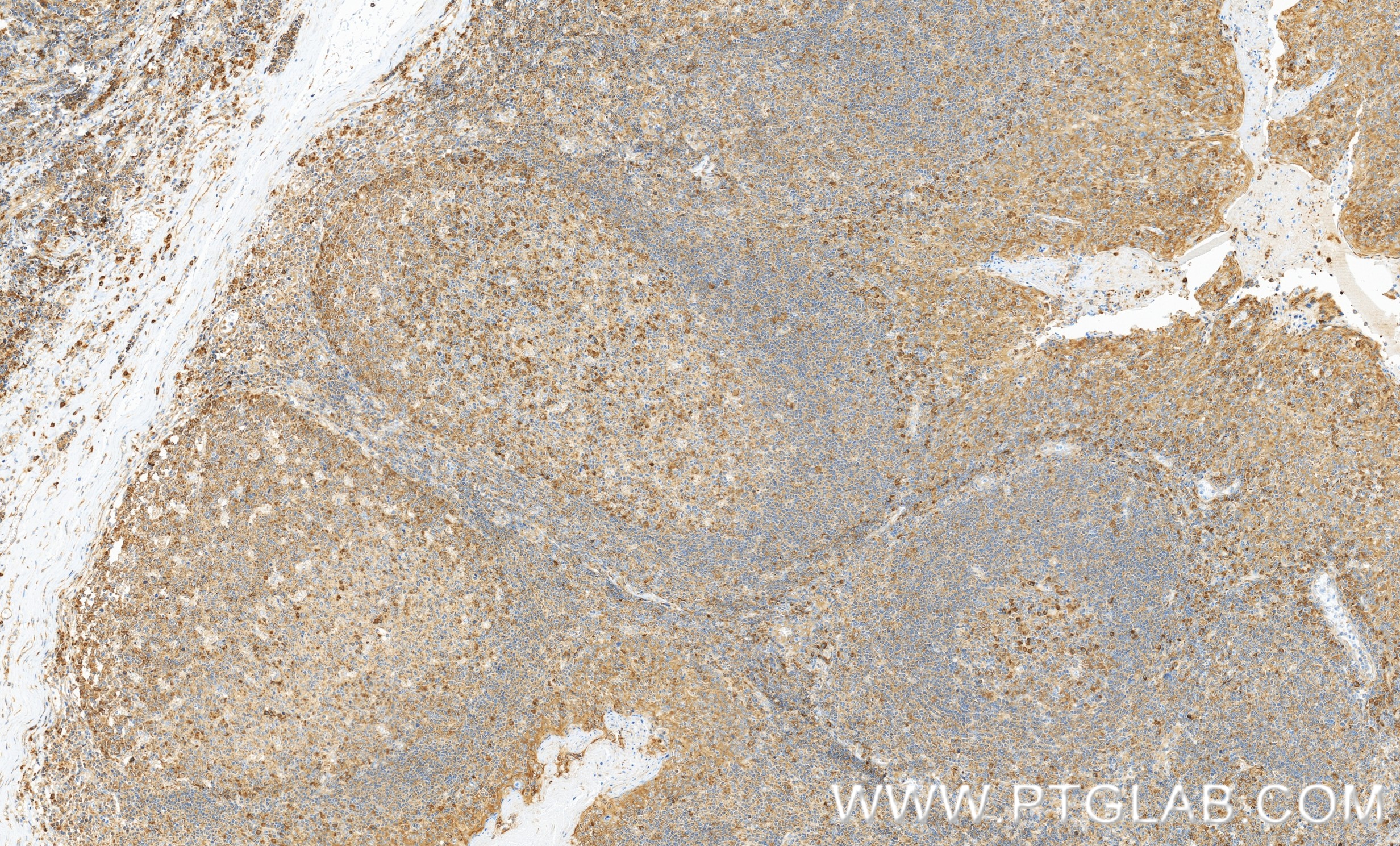 IHC staining of human tonsillitis using 86520-1-RR IHC staining of human tonsillitis using 86520-1-RR