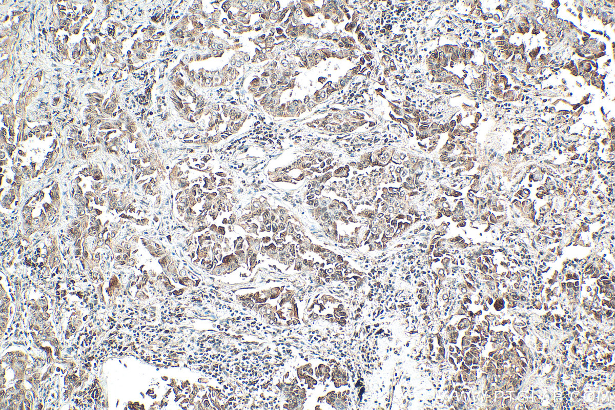 IHC staining of human lung cancer using 16487-1-AP