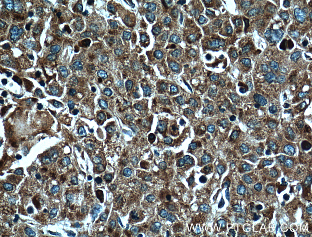 IHC staining of human liver cancer using 66130-1-Ig