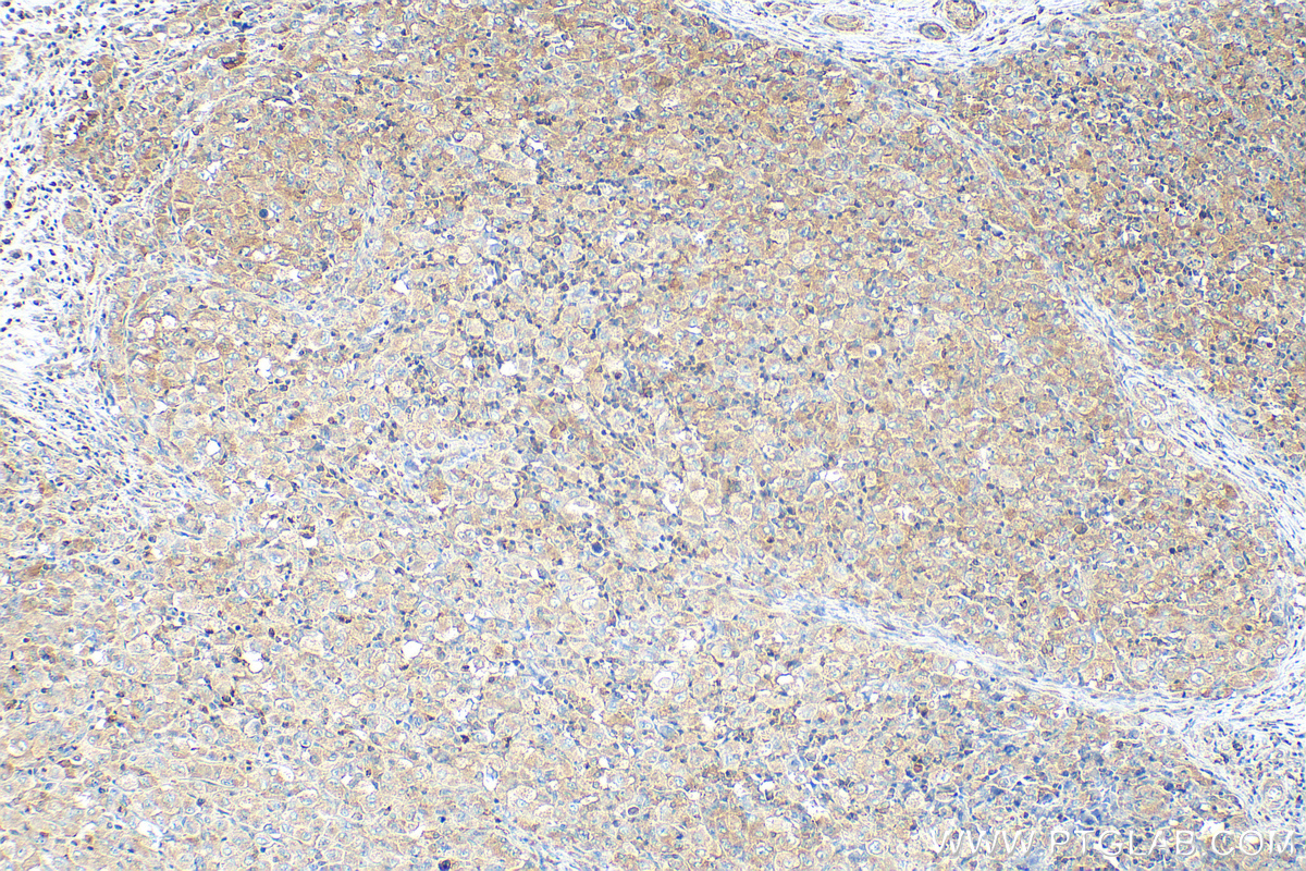 IHC staining of human lymphoma using 67028-1-Ig (same clone as 67028-1-PBS)