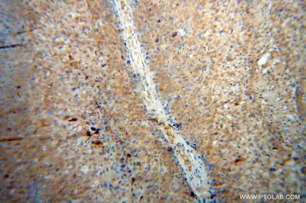 IHC staining of human skin cancer using 14583-1-AP