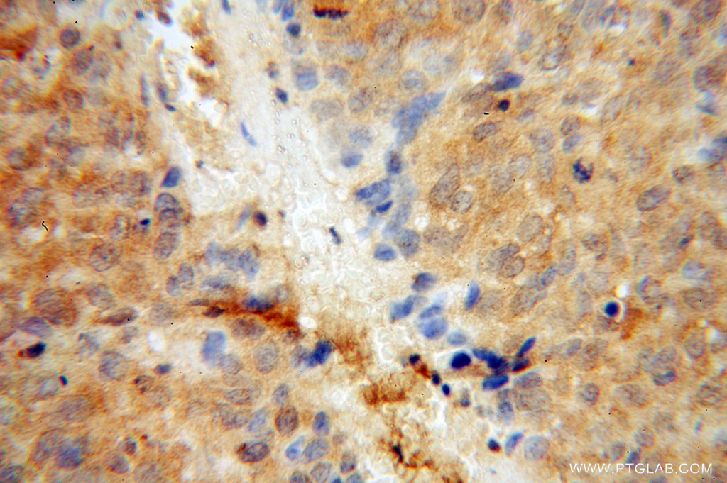 IHC staining of human skin cancer using 14583-1-AP