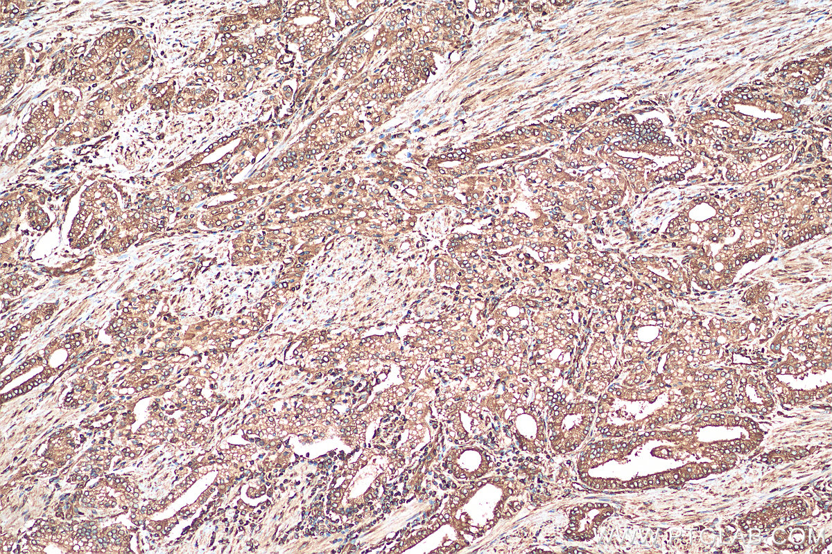 IHC staining of human prostate cancer using 21636-1-AP
