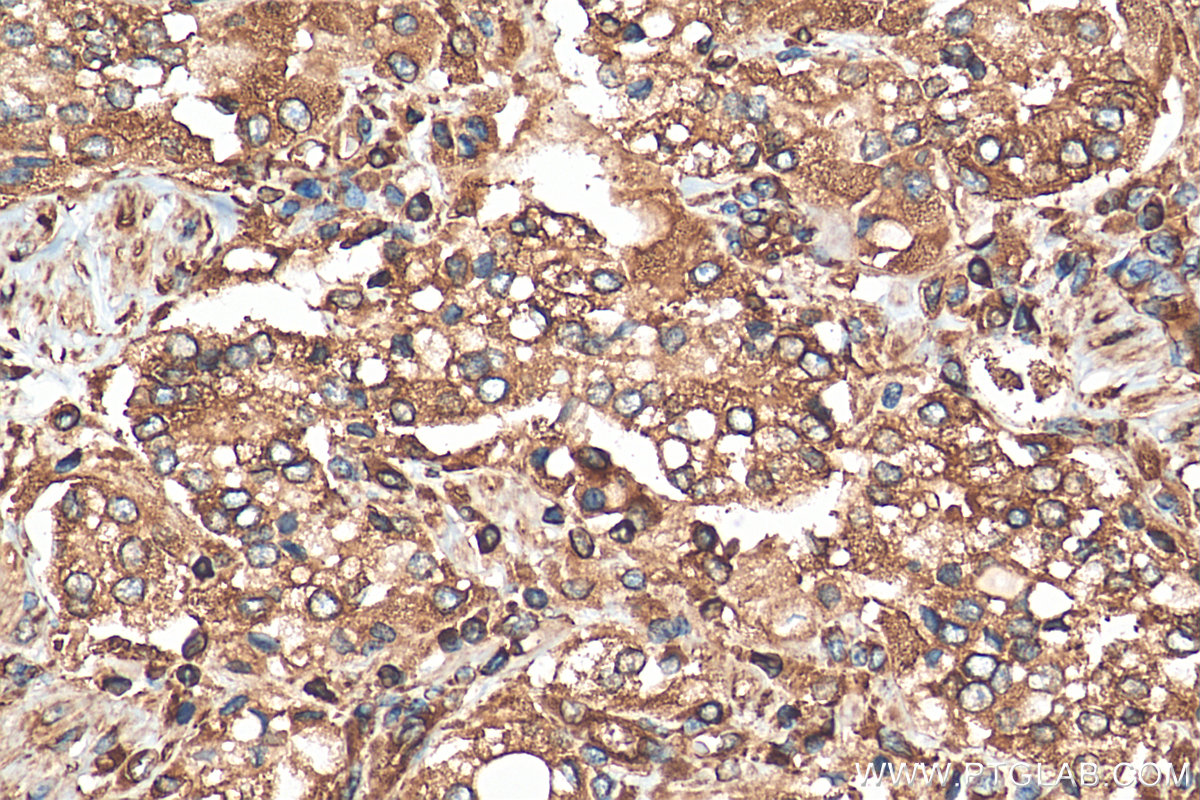 IHC staining of human prostate cancer using 21636-1-AP