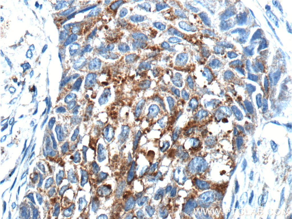 IHC staining of human lung cancer using 10576-1-AP