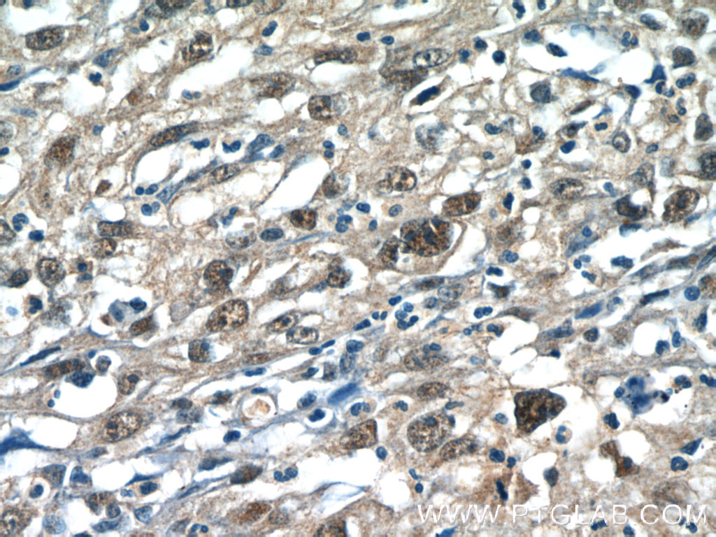 IHC staining of human cervical cancer using 15461-1-AP