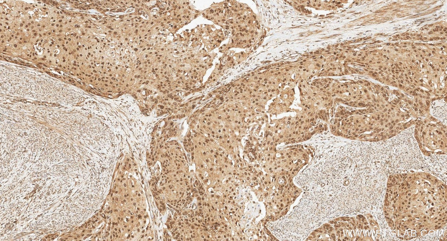 IHC staining of human cervical cancer using 24542-1-AP (same clone as 24542-1-PBS)