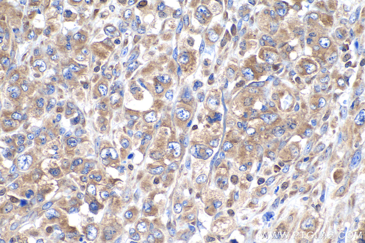 IHC staining of human lymphoma using 14957-1-AP