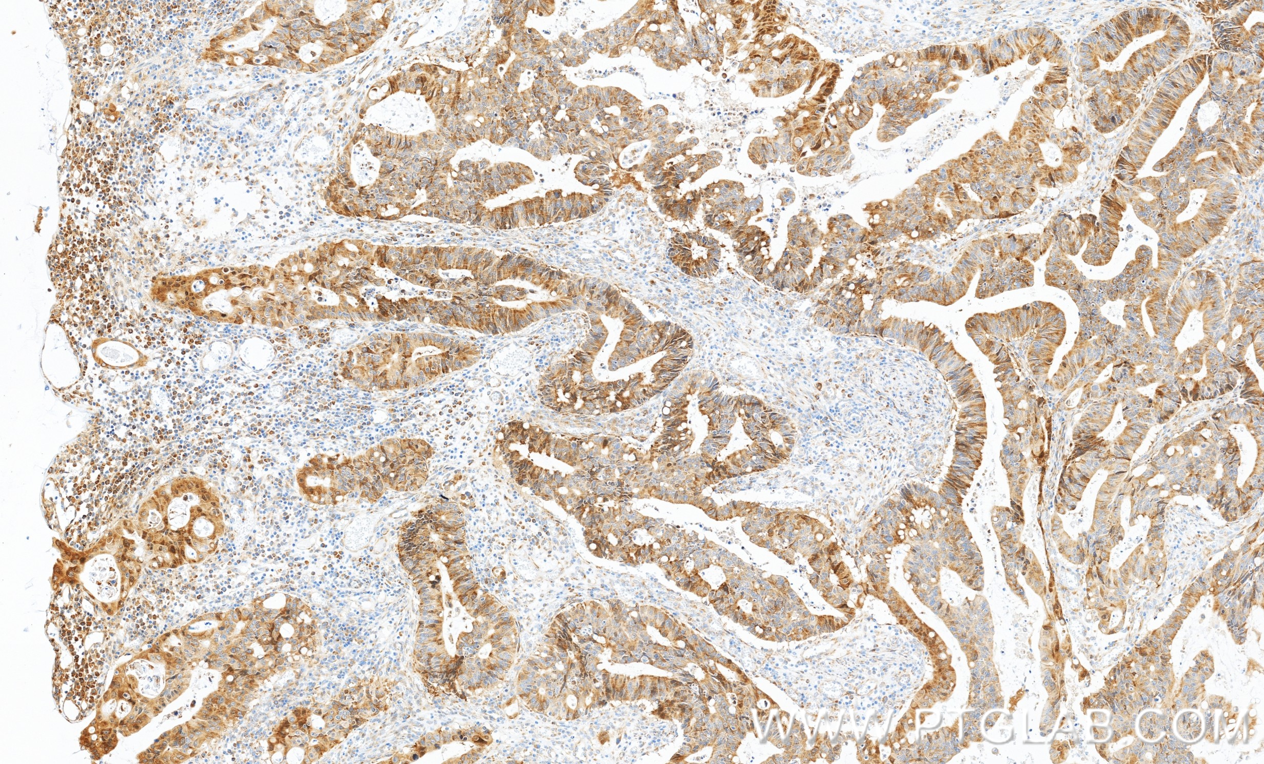 IHC staining of human colon cancer using 86318-2-RR