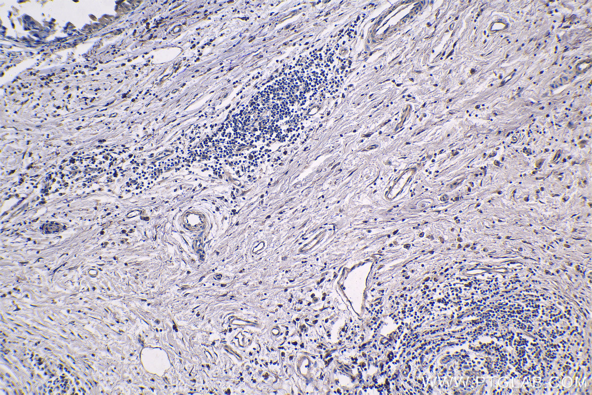 IHC staining of human breast cancer using 68270-1-Ig