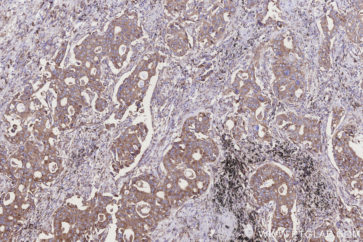 IHC staining of human lung cancer using 29834-1-AP (same clone as 29834-1-PBS)