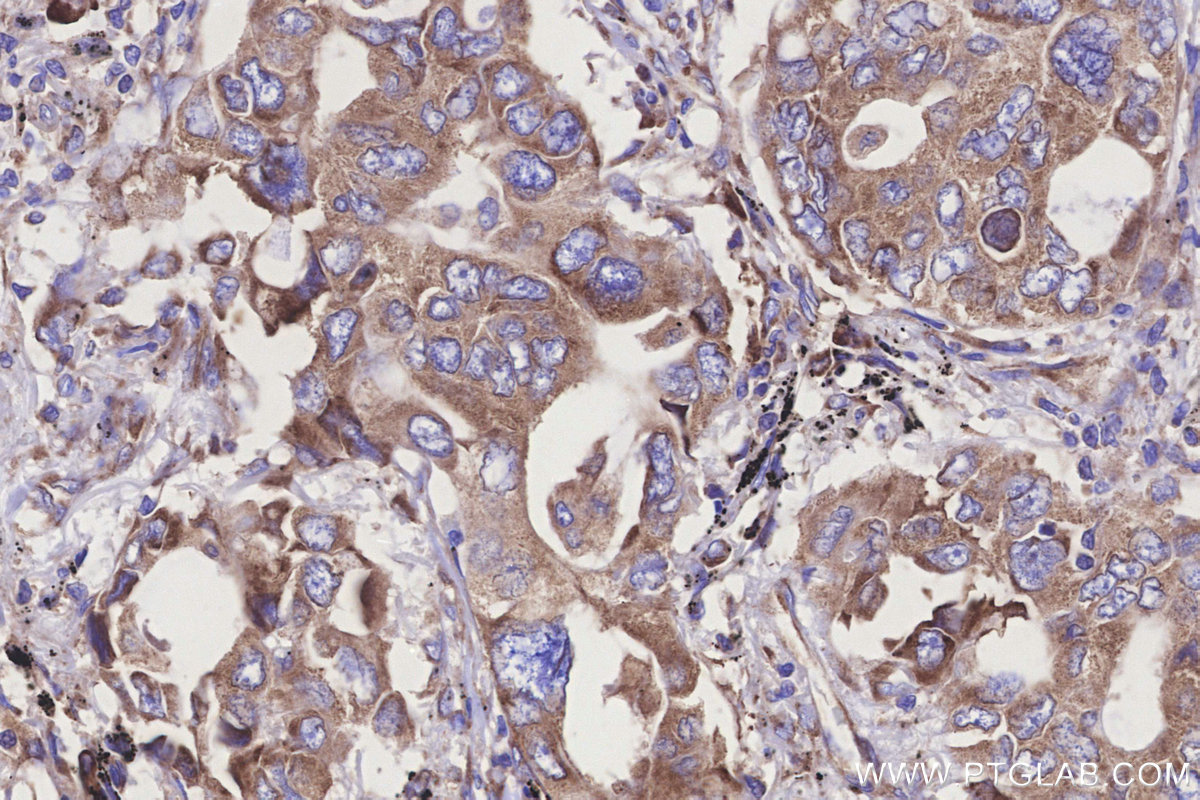 IHC staining of human lung cancer using 29834-1-AP (same clone as 29834-1-PBS)