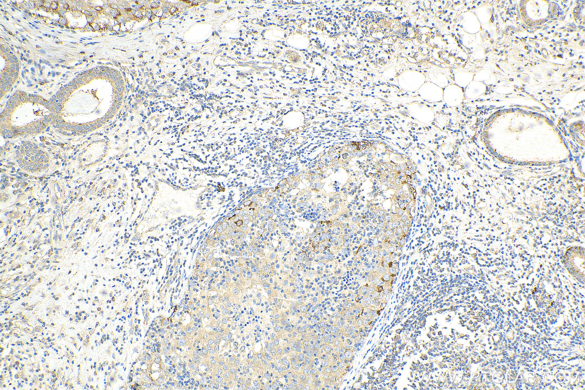 IHC staining of human breast cancer using 23599-1-AP