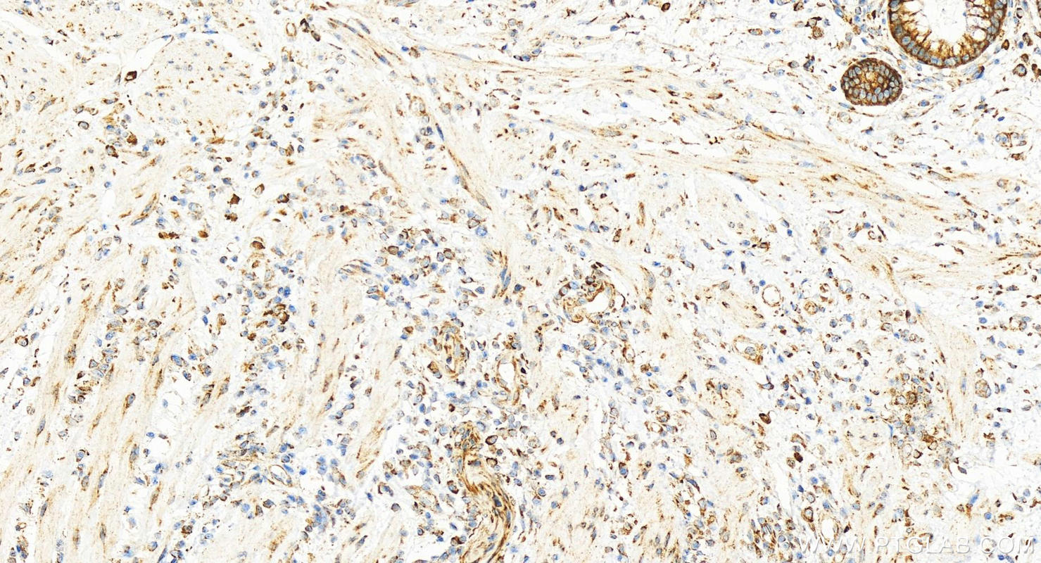 IHC staining of human colon cancer using 15198-1-AP