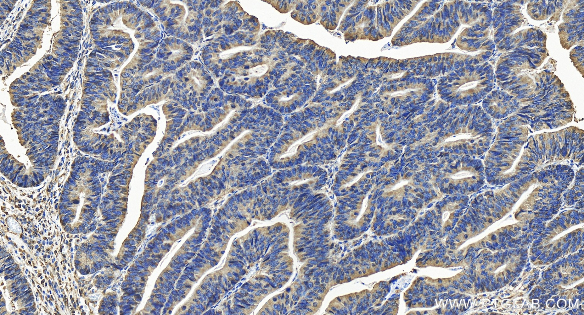 IHC staining of human colon cancer using 84947-4-RR