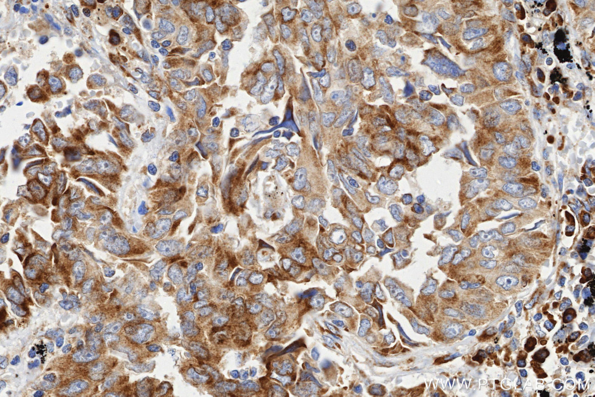 IHC staining of Human lung cancer (Adenocarcinoma) using 86254-3-RR IHC staining of Human lung cancer (Adenocarcinoma) using 86254-3-RR