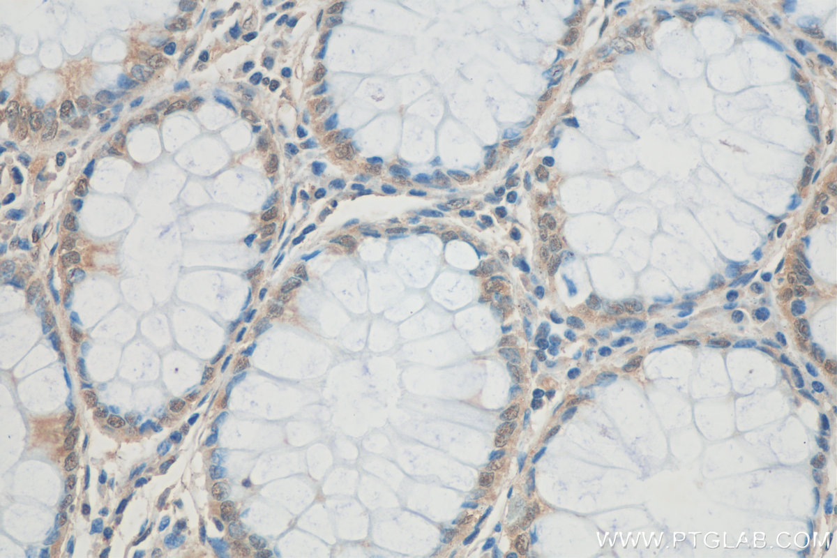 IHC staining of human colon cancer using 14823-1-AP