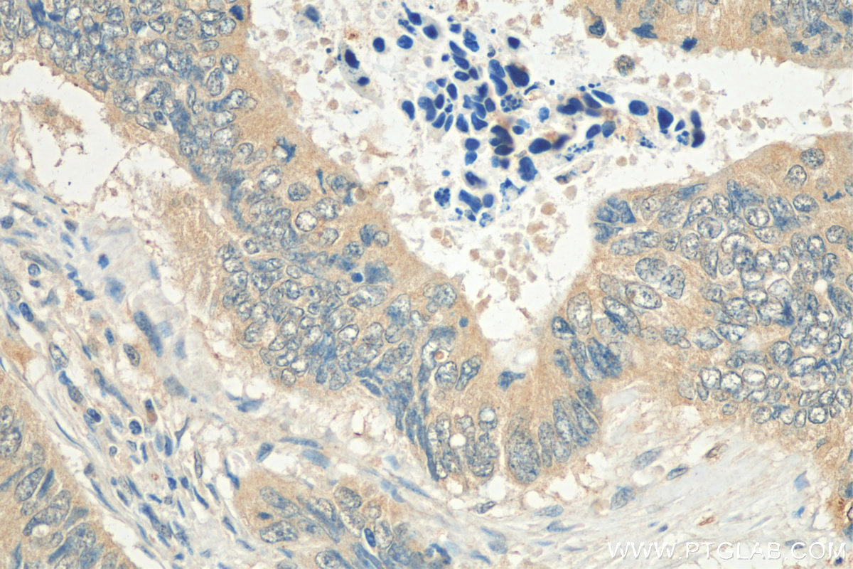 IHC staining of human colon cancer using 14823-1-AP
