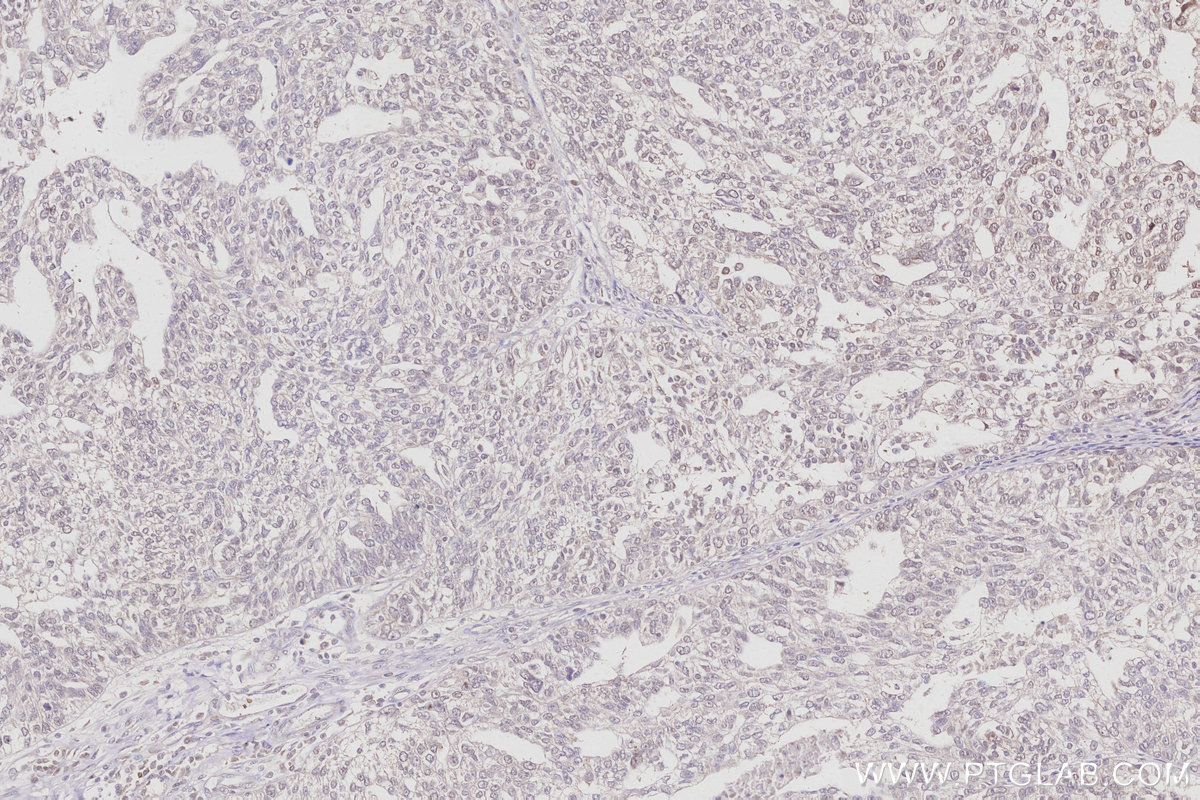 IHC staining of human ovary cancer using 15268-1-AP IHC staining of human ovary cancer using 15268-1-AP