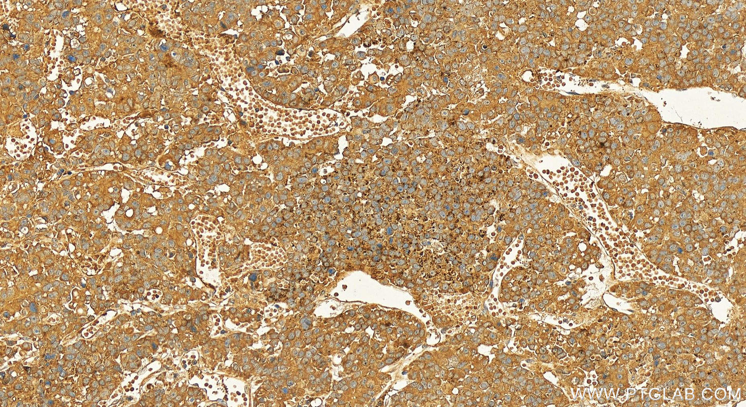Immunohistochemical analysis of paraffin-embedded human hepatocellular carcinoma slide using 20984-1-AP (Raptor antibody) at dilution of 1:200 (under 20x lens). Heat mediated antigen retrieval with Tris-EDTA buffer (pH 9.0). IHC staining of human hepatocellular carcinoma using 20984-1-AP