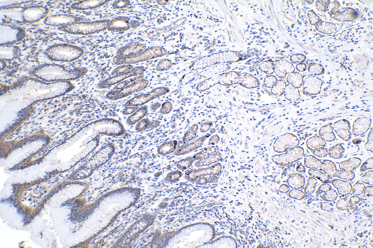 IHC staining of human stomach cancer using 22503-1-AP