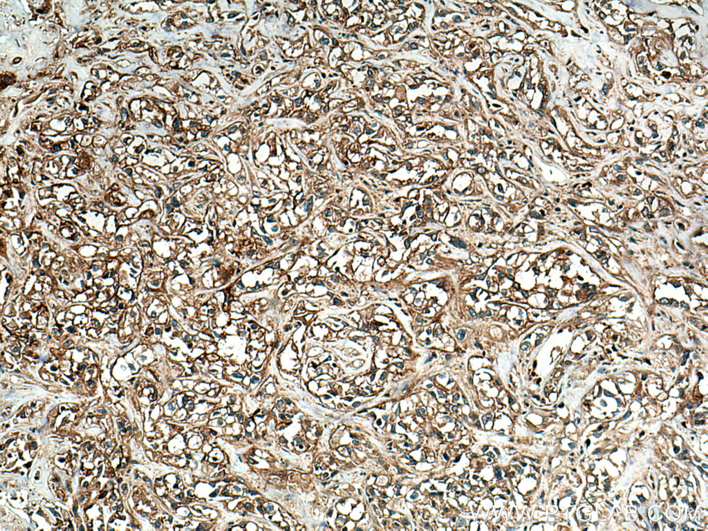 IHC staining of human renal cell carcinoma using 27457-1-AP