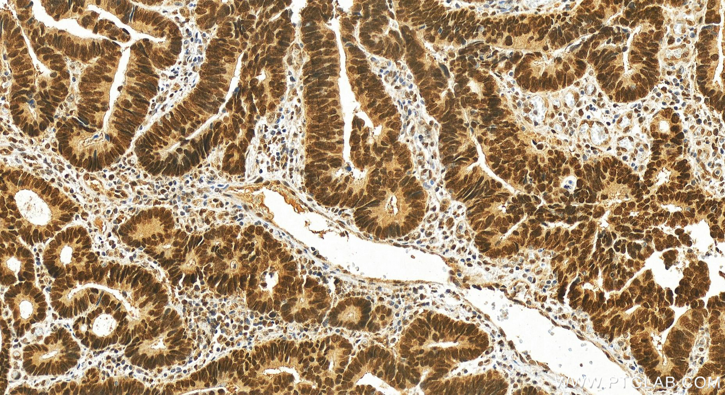 IHC staining of human colon cancer using 27706-1-AP