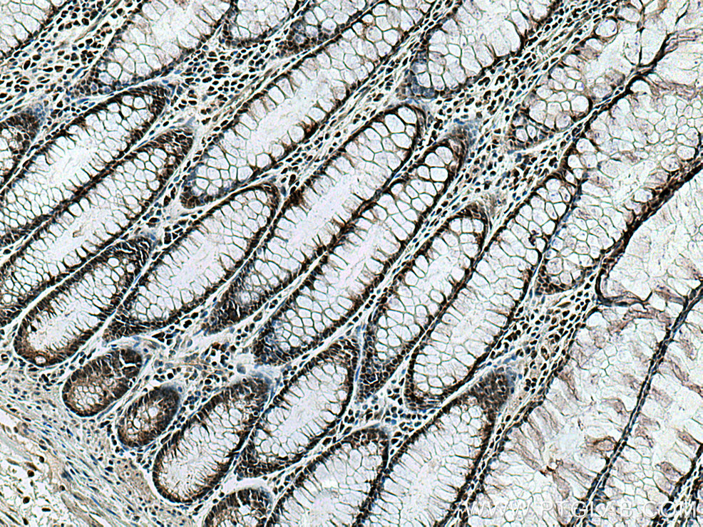 IHC staining of human colon cancer using 27706-1-AP