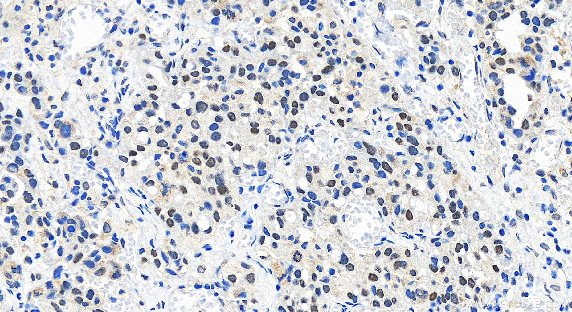 IHC staining of human ovary cancer using 27706-1-AP