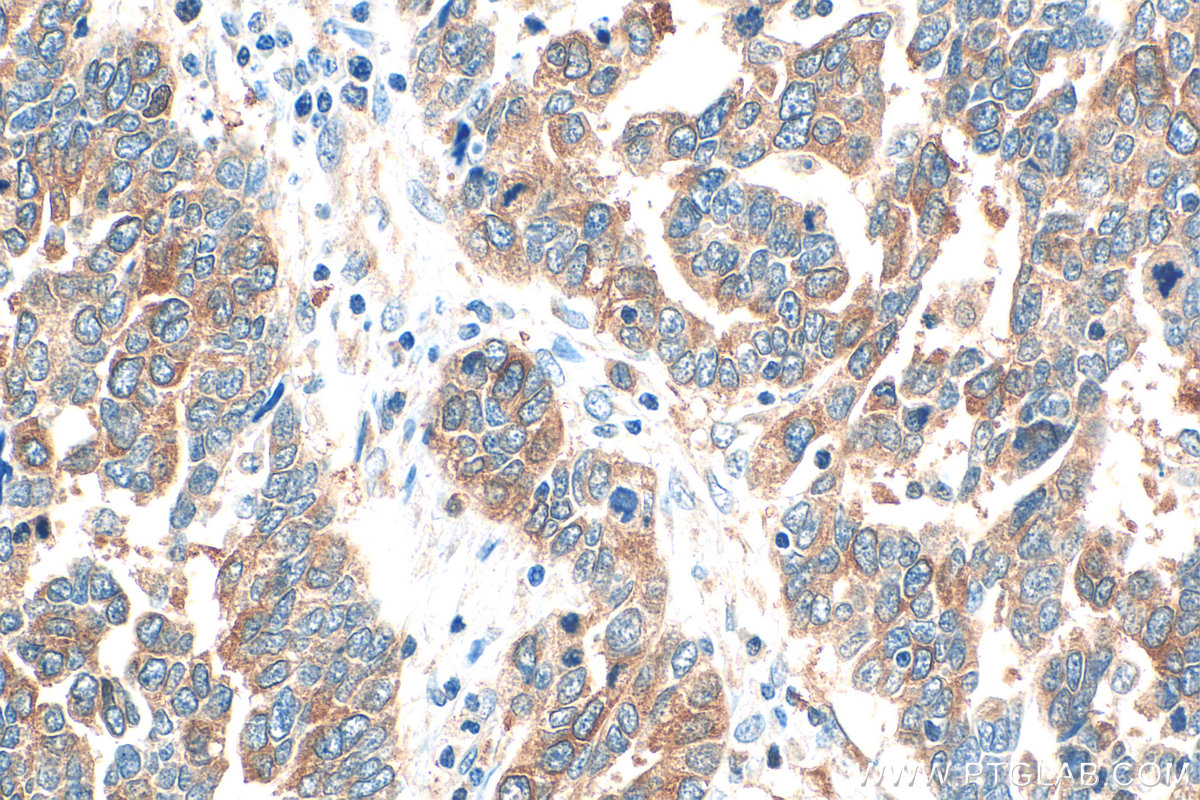 IHC staining of human ovary tumor using 10526-1-AP