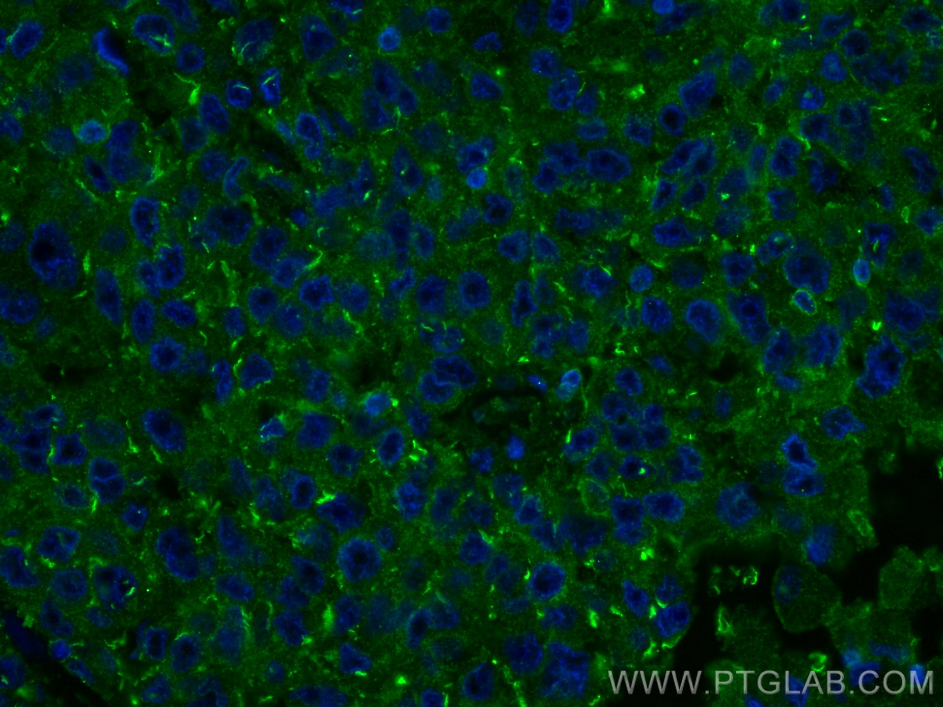 IF Staining of human breast cancer using 60073-2-Ig (same clone as 60073-2-PBS)