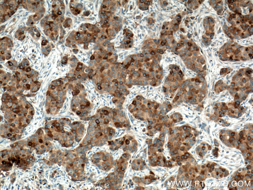 IHC staining of human breast cancer using 60073-2-Ig (same clone as 60073-2-PBS)