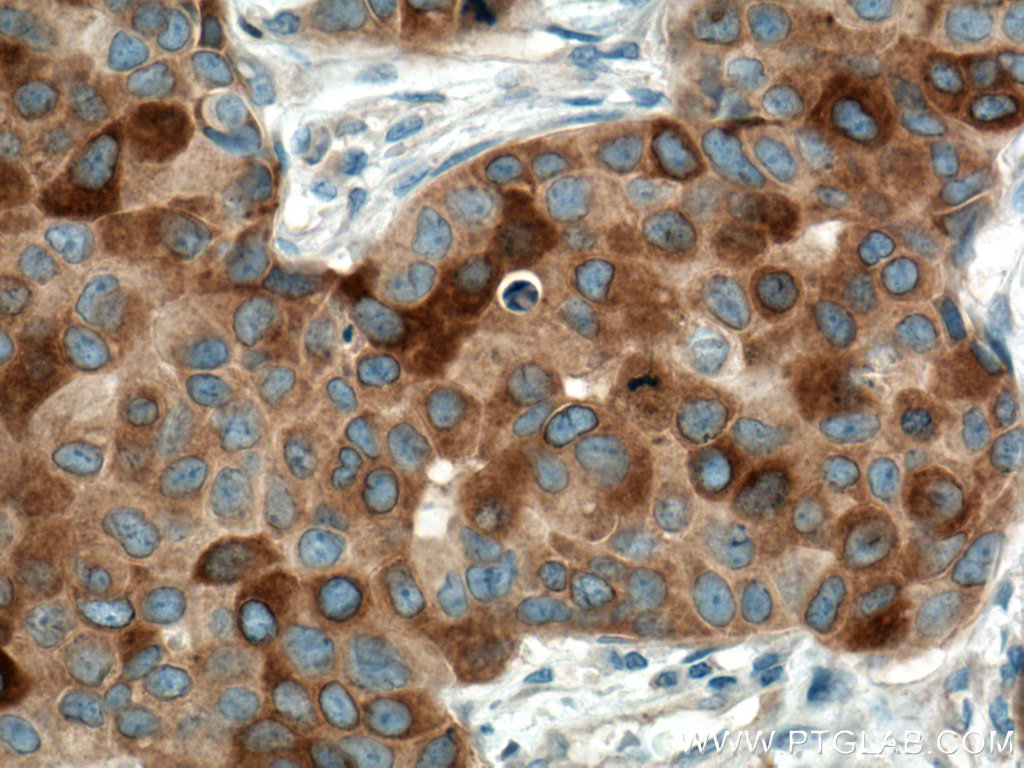 IHC staining of human breast cancer using 60073-2-Ig (same clone as 60073-2-PBS)