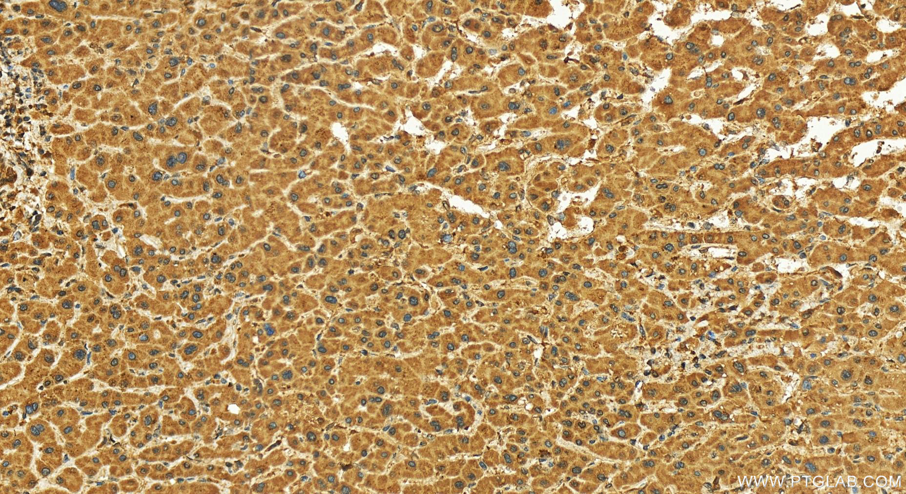 IHC staining of human intrahepatic cholangiocarcinoma using 27723-1-AP