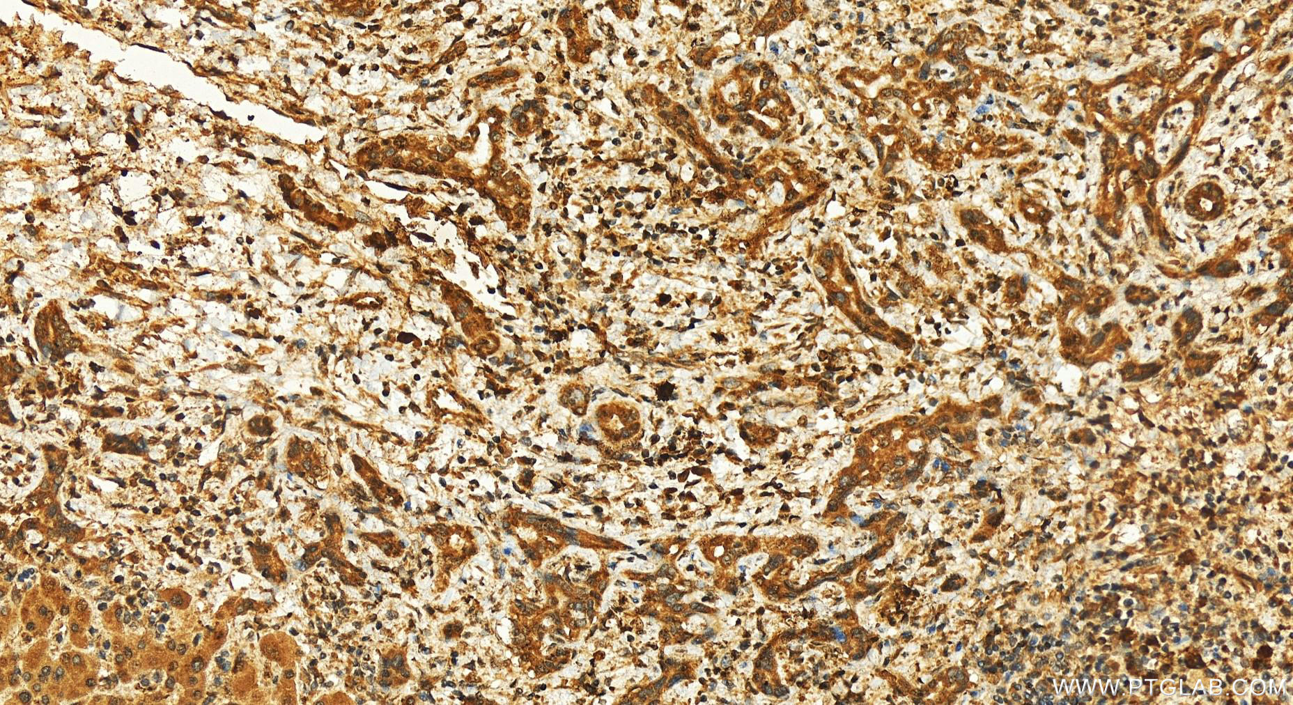 IHC staining of human intrahepatic cholangiocarcinoma using 27723-1-AP