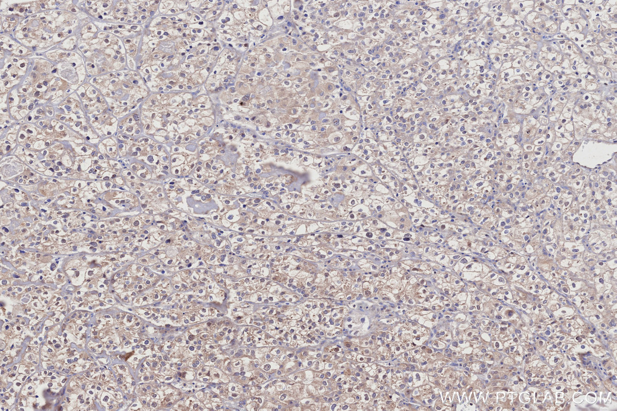 IHC staining of human endometrial cancer using 32033-1-AP
