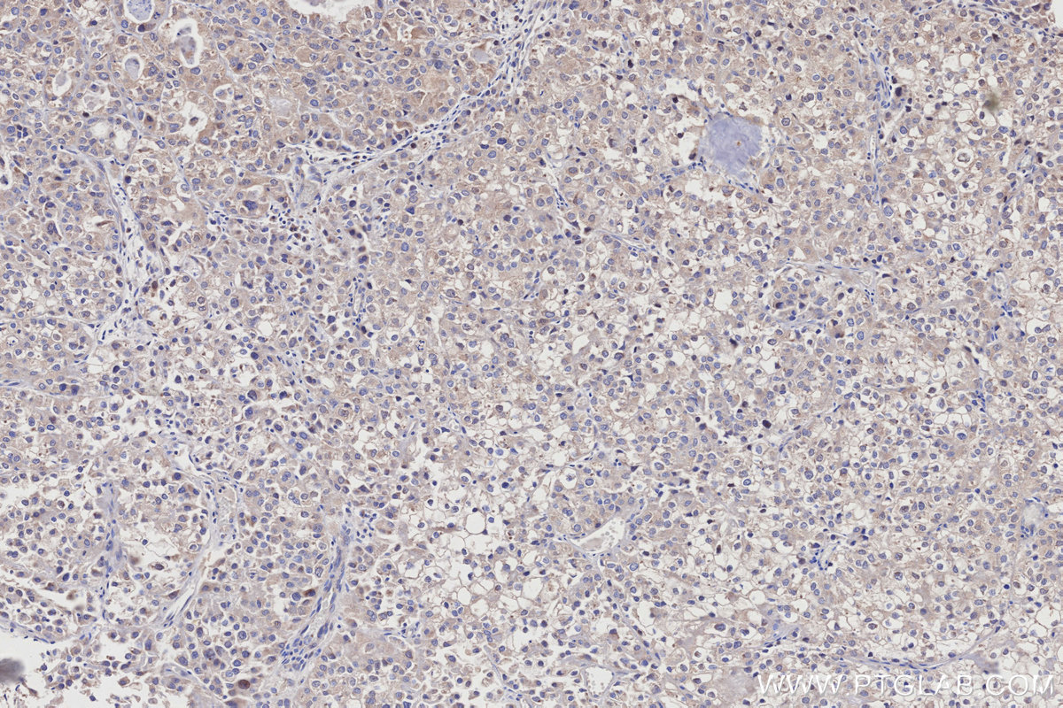 IHC staining of human endometrial cancer using 32033-1-AP